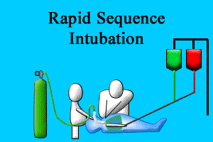 Rapid Sequence Intubation Image